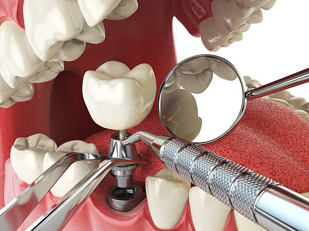 Best Emergency Treatment for Oral Infections in Longboat Key, FL